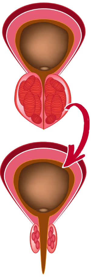 prostate transformation